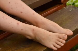 Closeup Childrens Legs Strewn with ulcers sores combed from insect bites