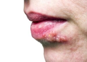 Herpes Lip